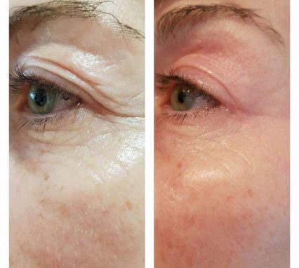 Bovenooglid, resultaat na drie weken DAS-plasma